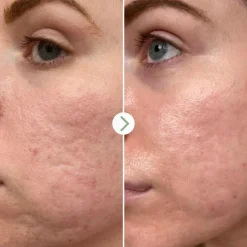 Pai Hyaluronic Acid 0.3% Hydrating booster seerumi 10ml