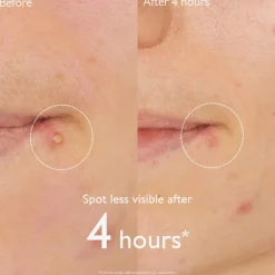 Vinopure Salicylic Spot Solution - 15 ml