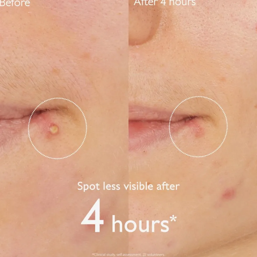 Vinopure Salicylic Spot Solution - 15 ml